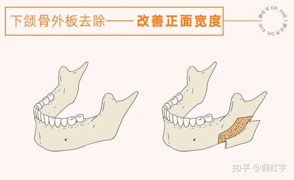 削下颌前你得知道什么是下颌角肥大