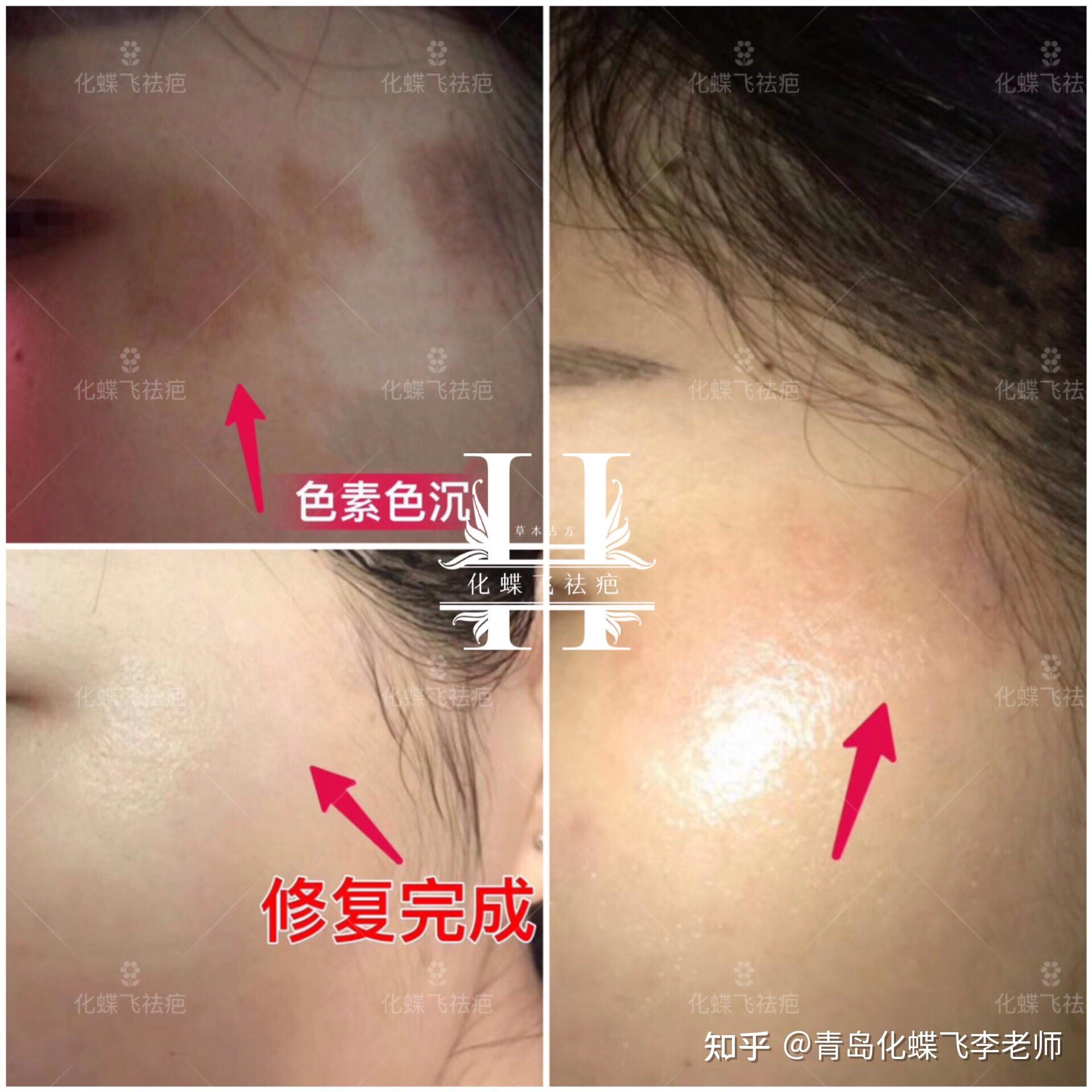 只要是色素沉淀,都可以用中药美肤液淡化 见效快且安全【色素疤痕修复