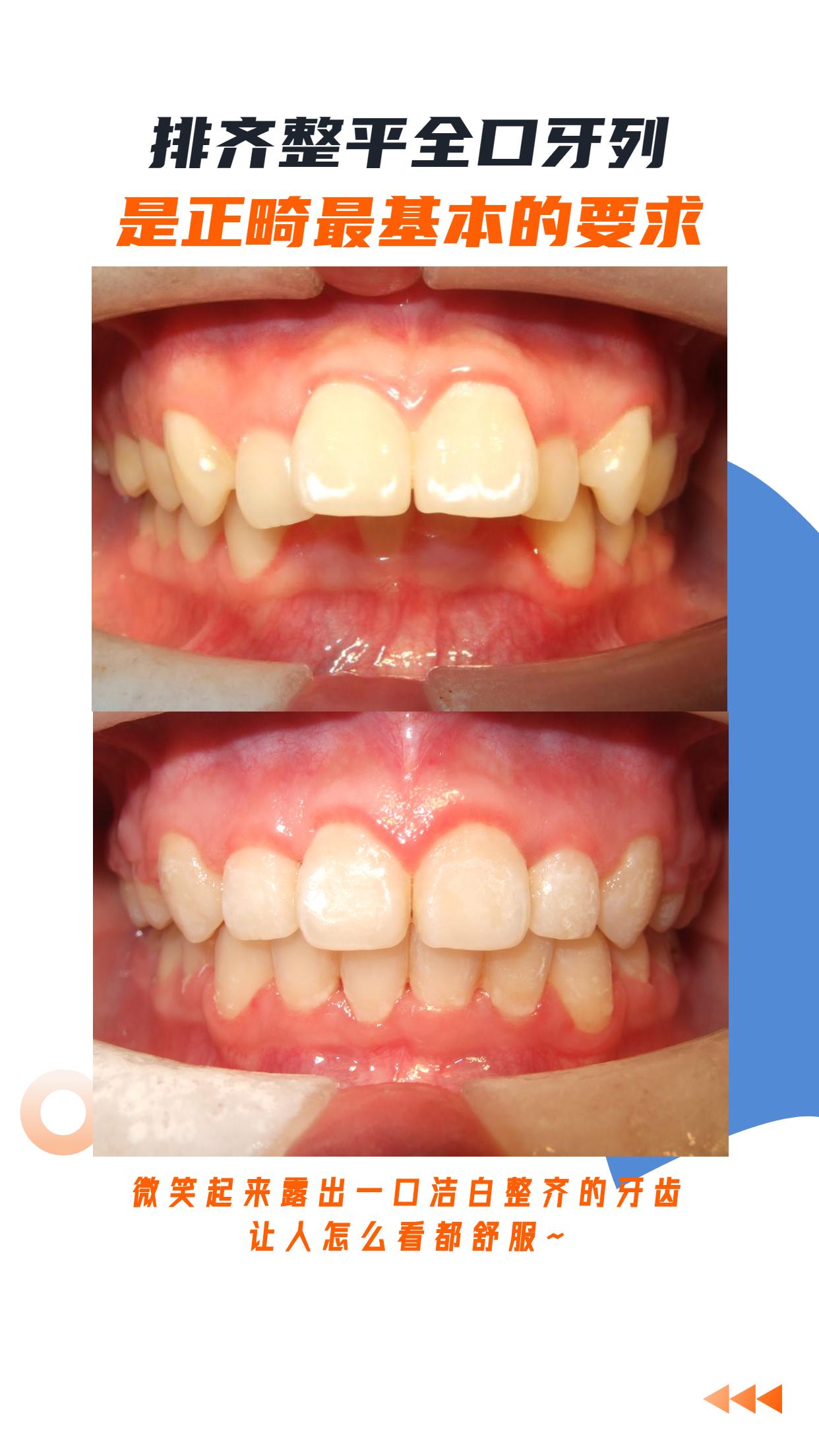 西安牙齿矫正排齐全口牙列是正畸最基本的要求