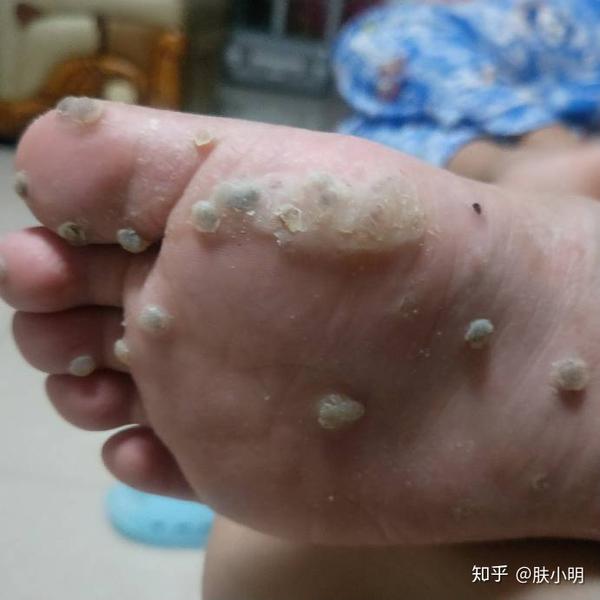 跖疣为什么会复发?