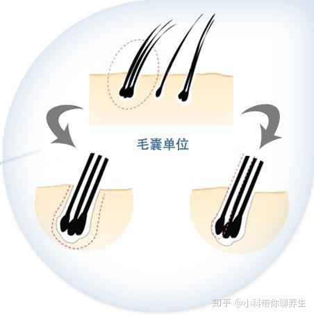 但是我们回到根本,影响头发生长的其实是毛囊,如果毛囊不健康就会引发