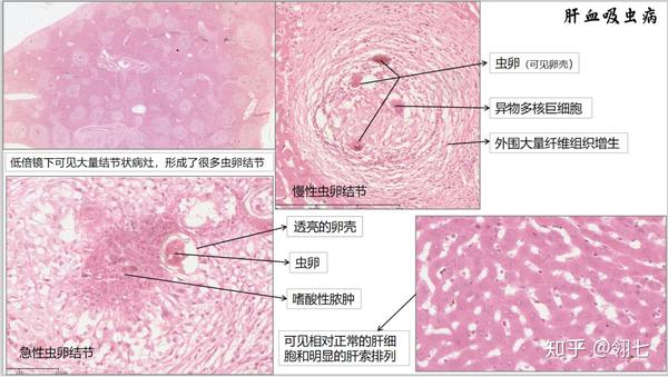 巨噬细胞形成类上皮细胞,异物多核巨细胞由多个类上皮细胞聚集融合或