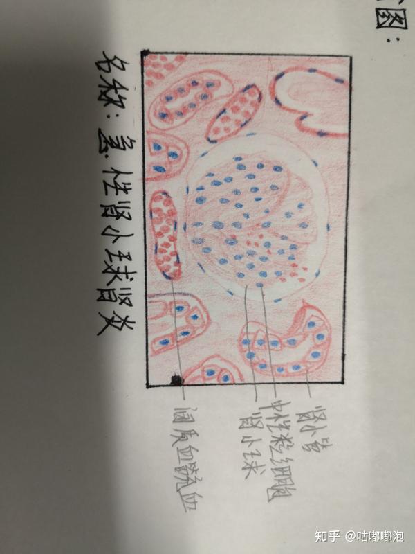 30.慢性肾小球肾炎