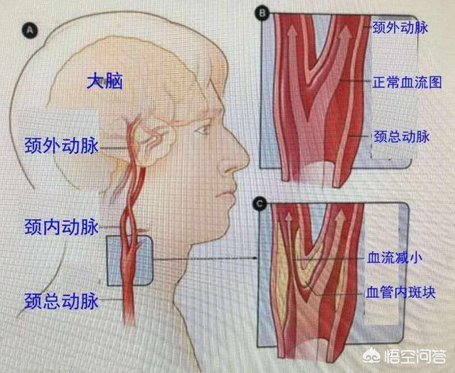 颈动脉血管一堵身体会出现哪些提醒信号