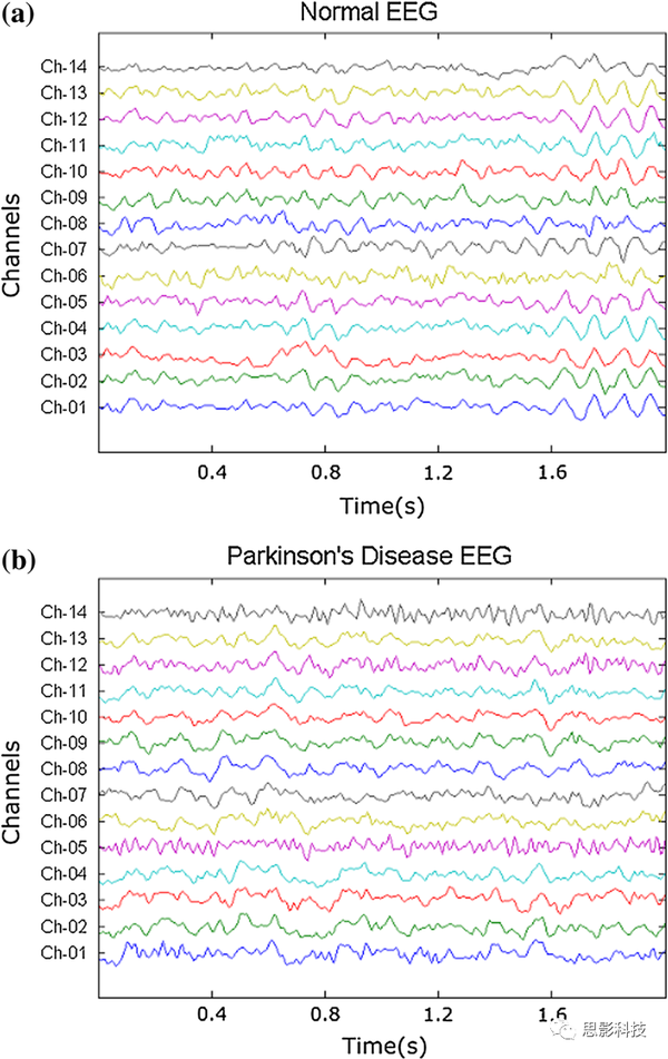 用脑电信号诊断帕金森病的一种深度学习方法