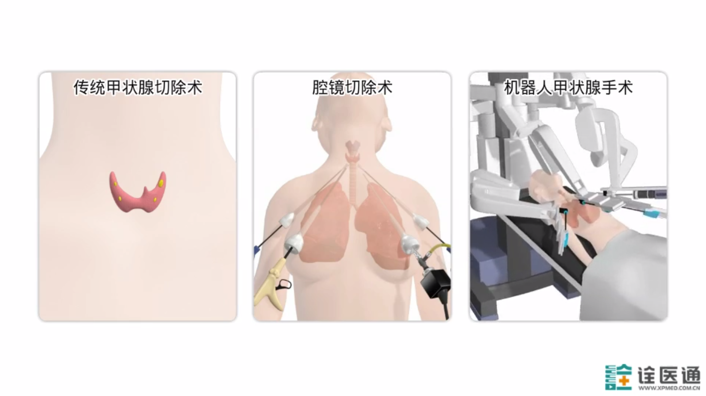 甲状腺术后颈部功能锻炼40           赞同视频