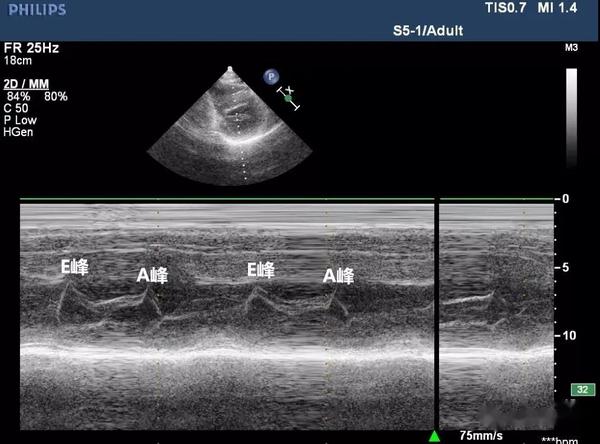 心脏彩超报告怎么看二尖瓣狭窄与二尖瓣关闭不全解读 知乎