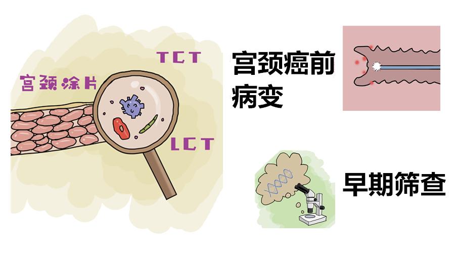 预防宫颈癌有效方法宫颈癌前病变的早期筛查