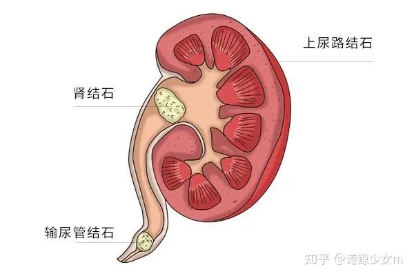 太晚吃晚餐易患肾结石肾结石吃那些对身体好了