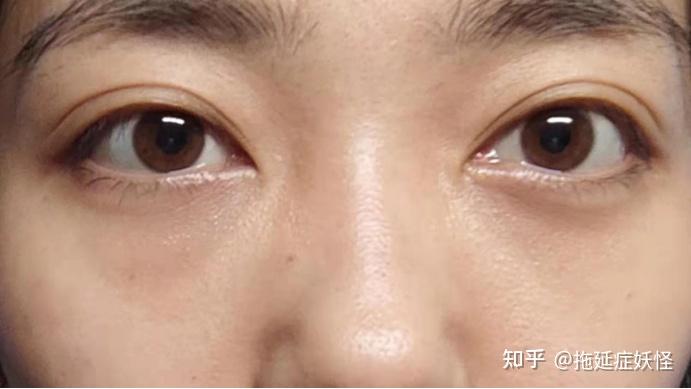 怎么拯救特别严重的黑眼圈