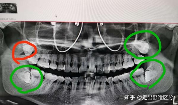 低位阻生齿 知乎