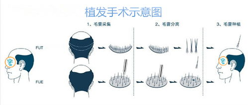 发际线太高植发可行吗