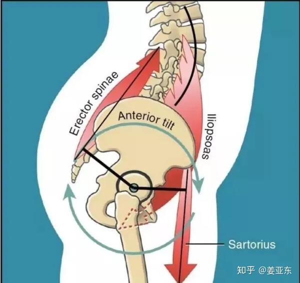 1,体姿态改变——骨盆前倾和腰椎前凸 久坐人群不仅屈髋肌过于紧张