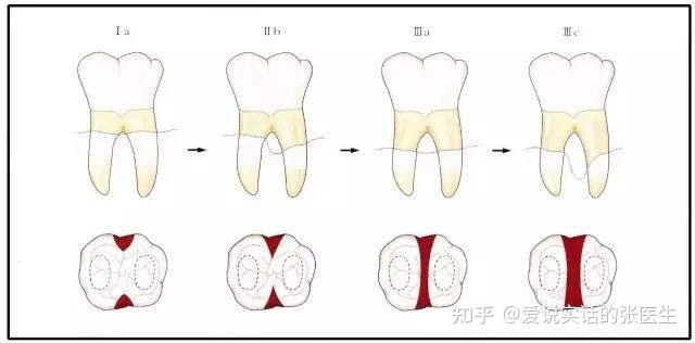 基础治疗后的四到六周如果发现个别或多个位置牙周袋深度仍然≥5mm这