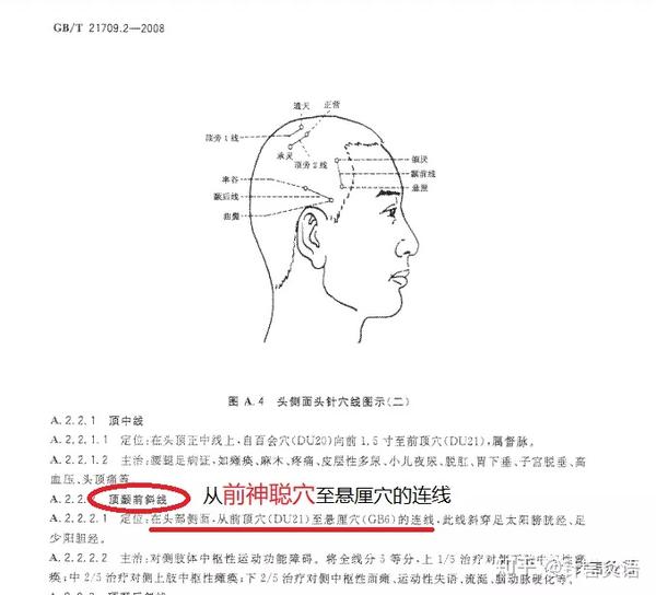 中风系列│头针疗法治疗中风
