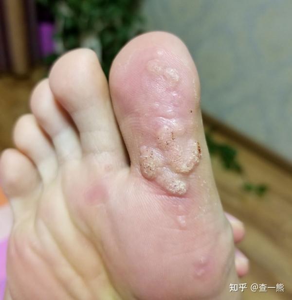 跖疣激光冷冻复发,该怎么解决?