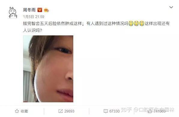 周冬雨拔智齿肿成表情包,你的智齿呢?