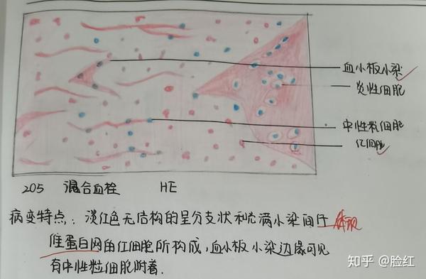 慢性肝淤血 慢性肺淤血