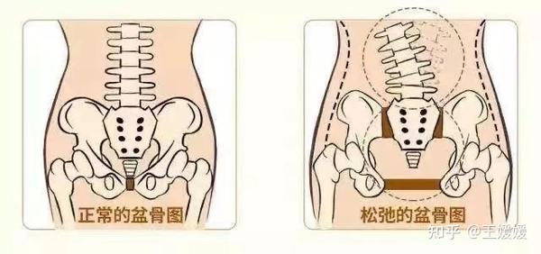产后骨盆变形,耻骨联合分离,问题出在哪里