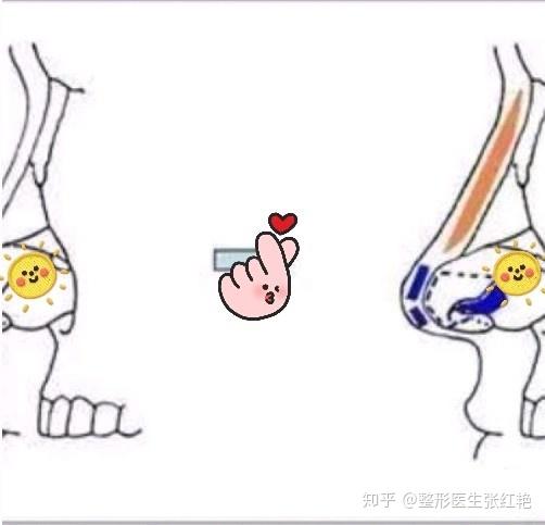 耳软骨隆鼻竟然会让耳朵变残废