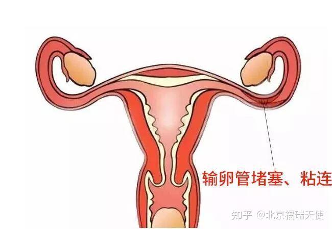 输卵管堵塞,手术还是试管?——北京福瑞天使