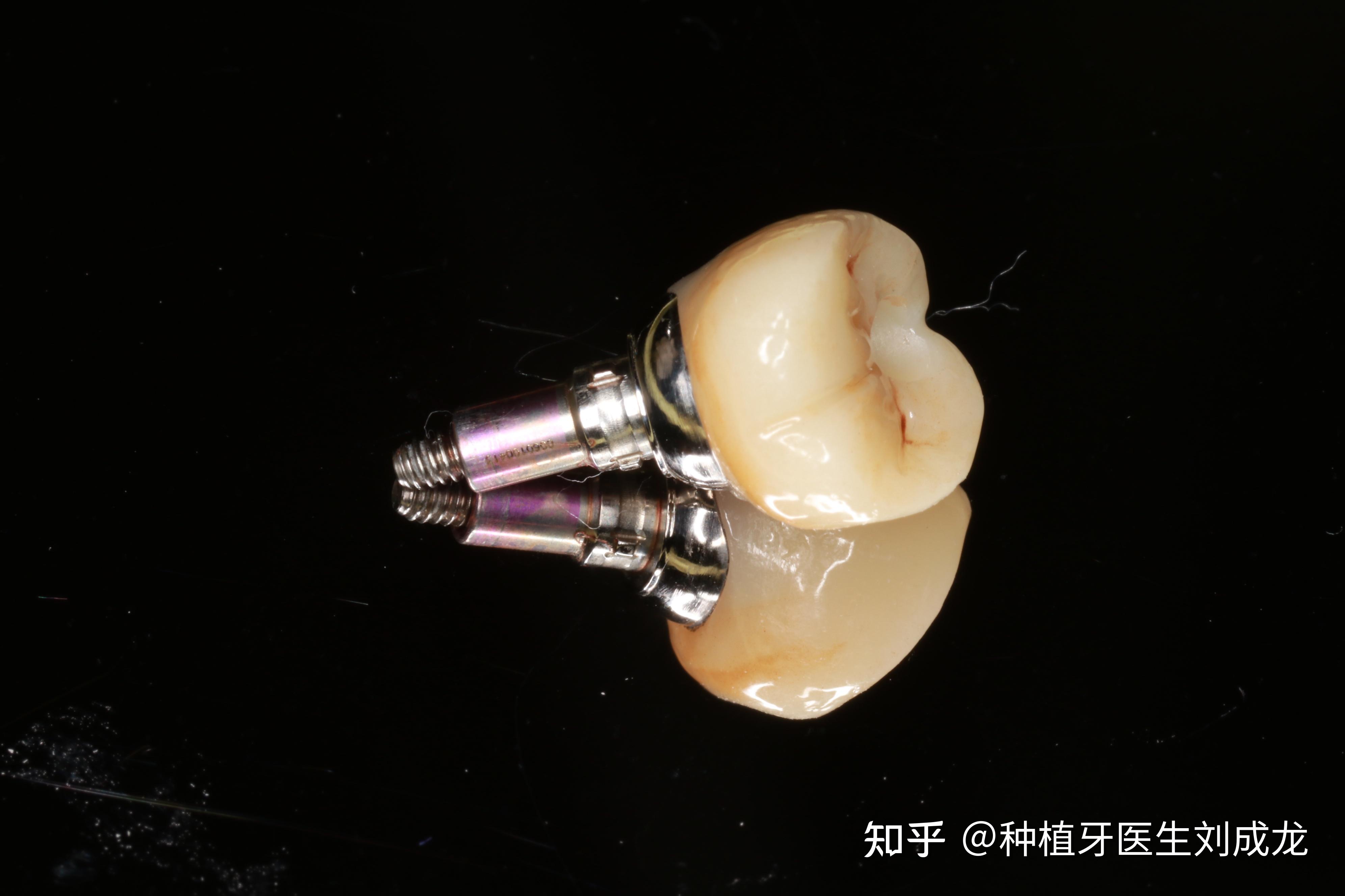 郑州种植牙下颌单颗德国camlog种植修复案例