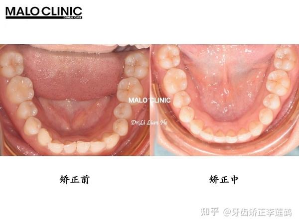 北京隐适美丨深覆盖,前牙内扣,要怎么矫正?