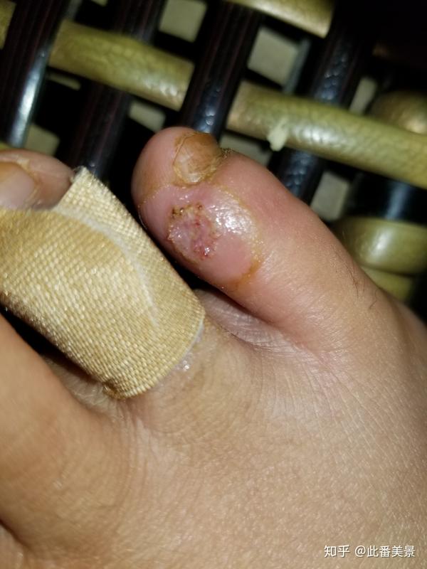 我的跖疣治疗经历(带图慎点)