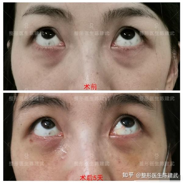 求助各位姐妹做完祛眼袋手术黑眼圈还是很重