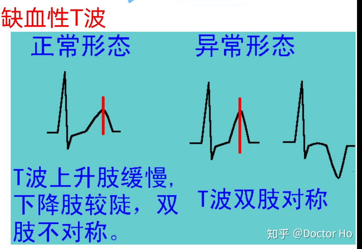 从而在心电图上引起st-t的异常改变