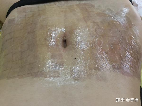 点阵激光祛妊娠纹