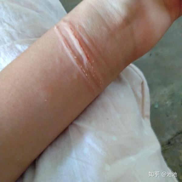 胳膊上肿的是用扇子摔的