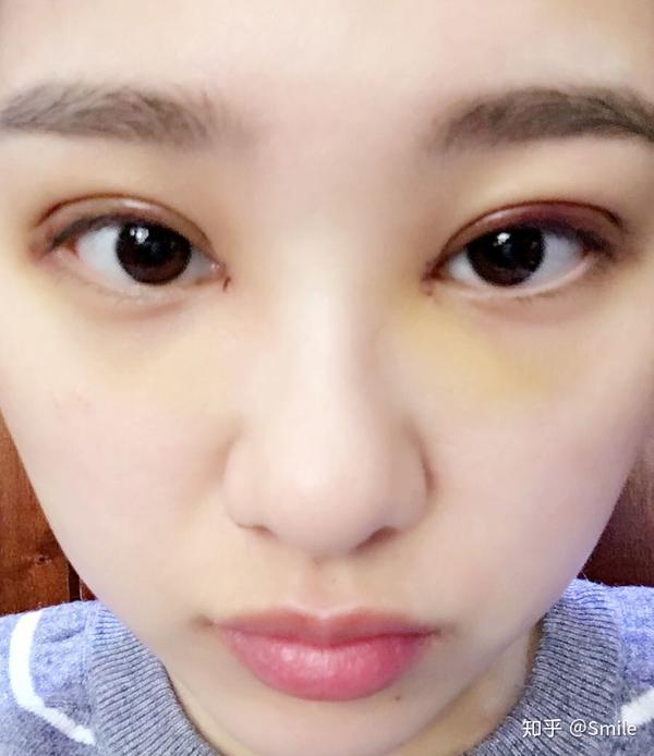 合肥双眼皮术后过程记录~内双调整