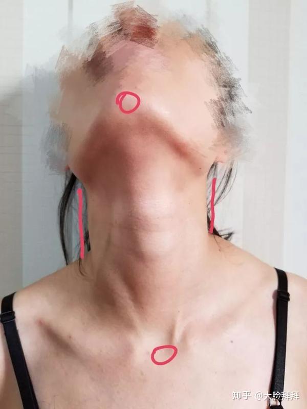 脖子两侧长度正常应该接近,长度不一致证明头是歪的.