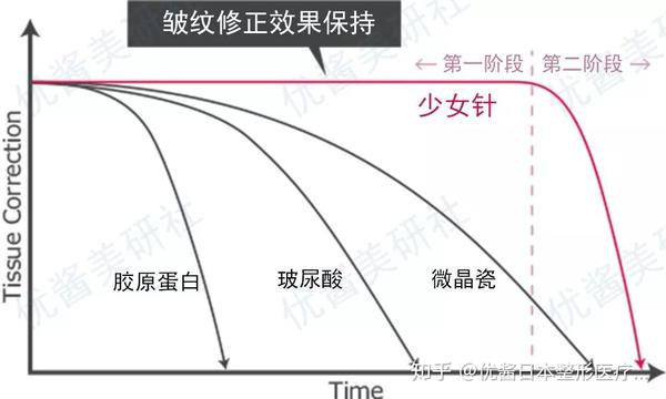 第一阶段少女针在施术后可以保持填充状态很长一段时