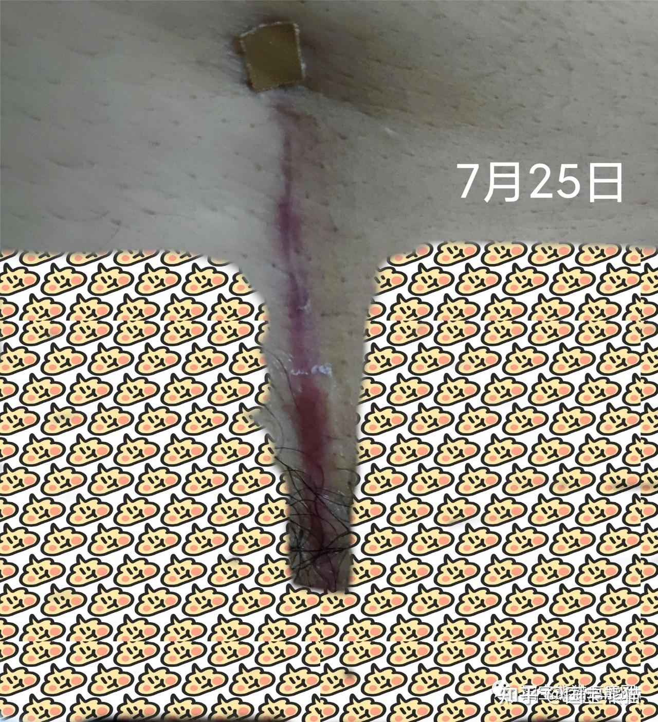 咨询答疑:外科术后免拆线缝合好还是美容线缝合好?