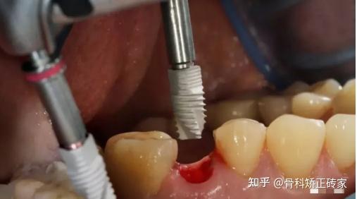 种植牙修复过程中常出现的并发症及其处理