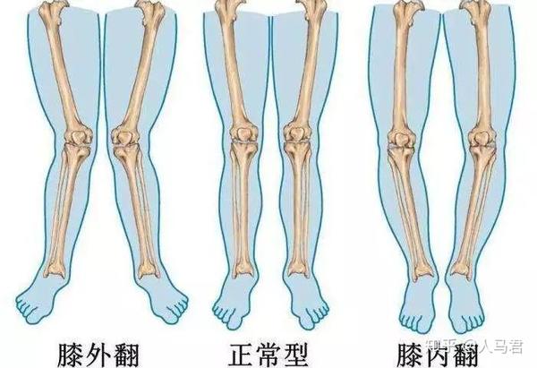 走路时,足的长轴可以有轻度外旋,与步伐前进的方向在5 -110°.