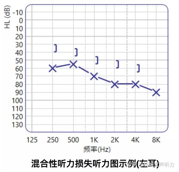 03 混合性听力损失 气骨导阈值都不在正常范围内,且气骨导阈值差值