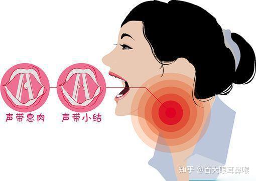 痰鸣音是什么声音 zhuanlan.zhihu.com
