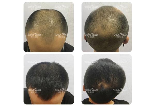 治疗脱发,你为什么抗拒使用米诺地尔?