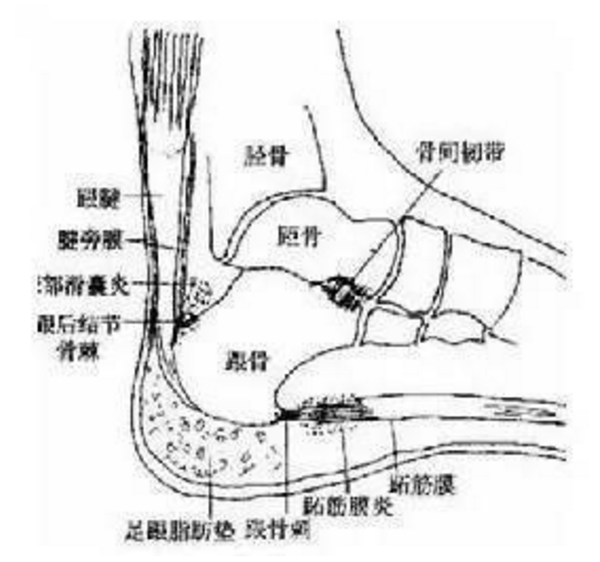 四,跟腱炎