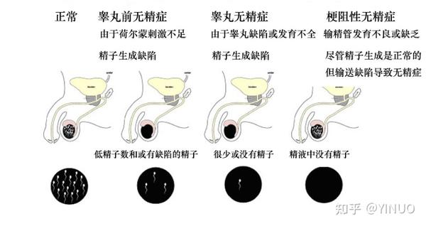 无精子症(英语:azoospermia)是指男性精液中没有精子的症状.