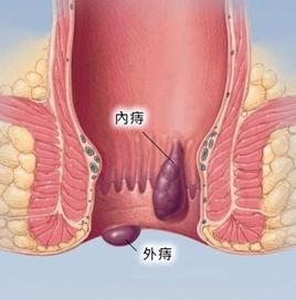 如何辨别肛裂肛瘘痔疮