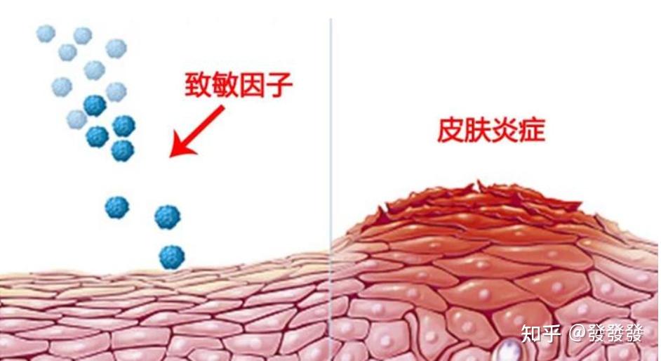 和抗氧化同等重要做好皮肤抗炎才是解决皮肤问题的关键