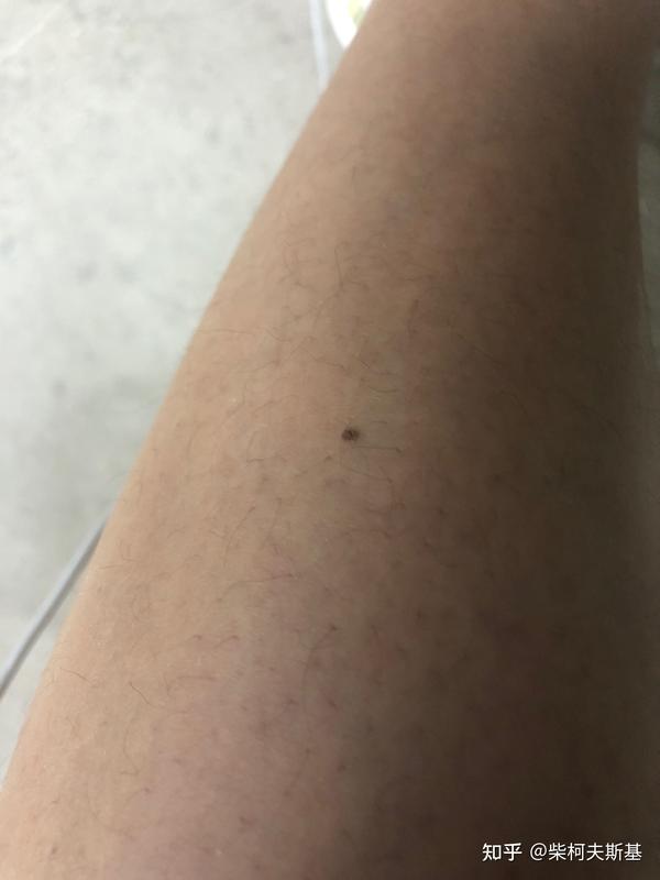 扁平疣是可以治愈的