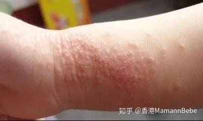 知识点湿疹在不同年龄段的特征及处理方法