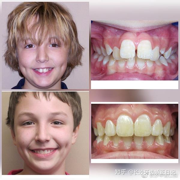 论牙齿矫正对一个人有多大的影响?