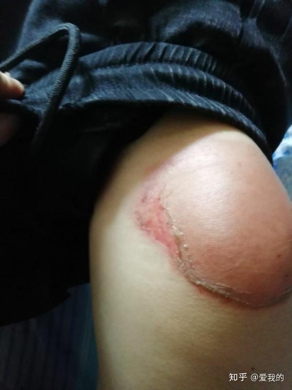 贴完膏药后起得水泡