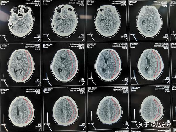 这是张先生的头部ct,红色标记就是颅内慢性硬膜下出血